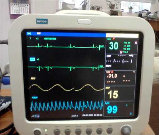Внешний вид средства измерений: Мониторы пациента , заводской номер №5092012117 